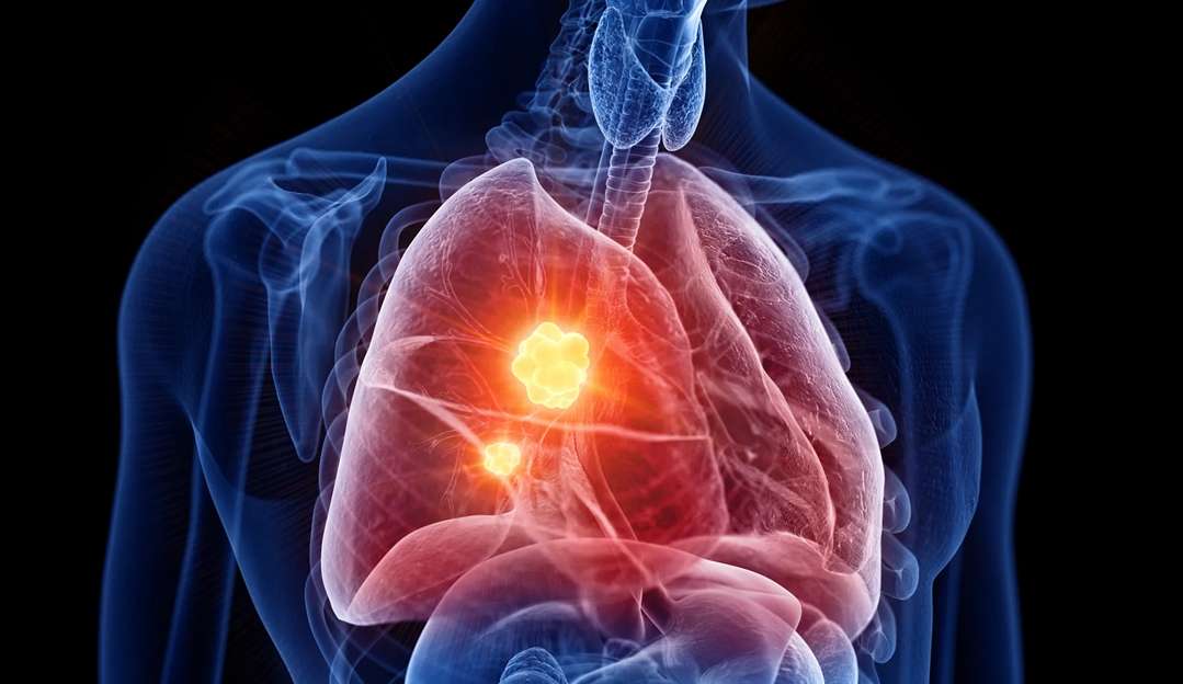 Confira quais são os 10 principais sintomas do câncer de pulmão