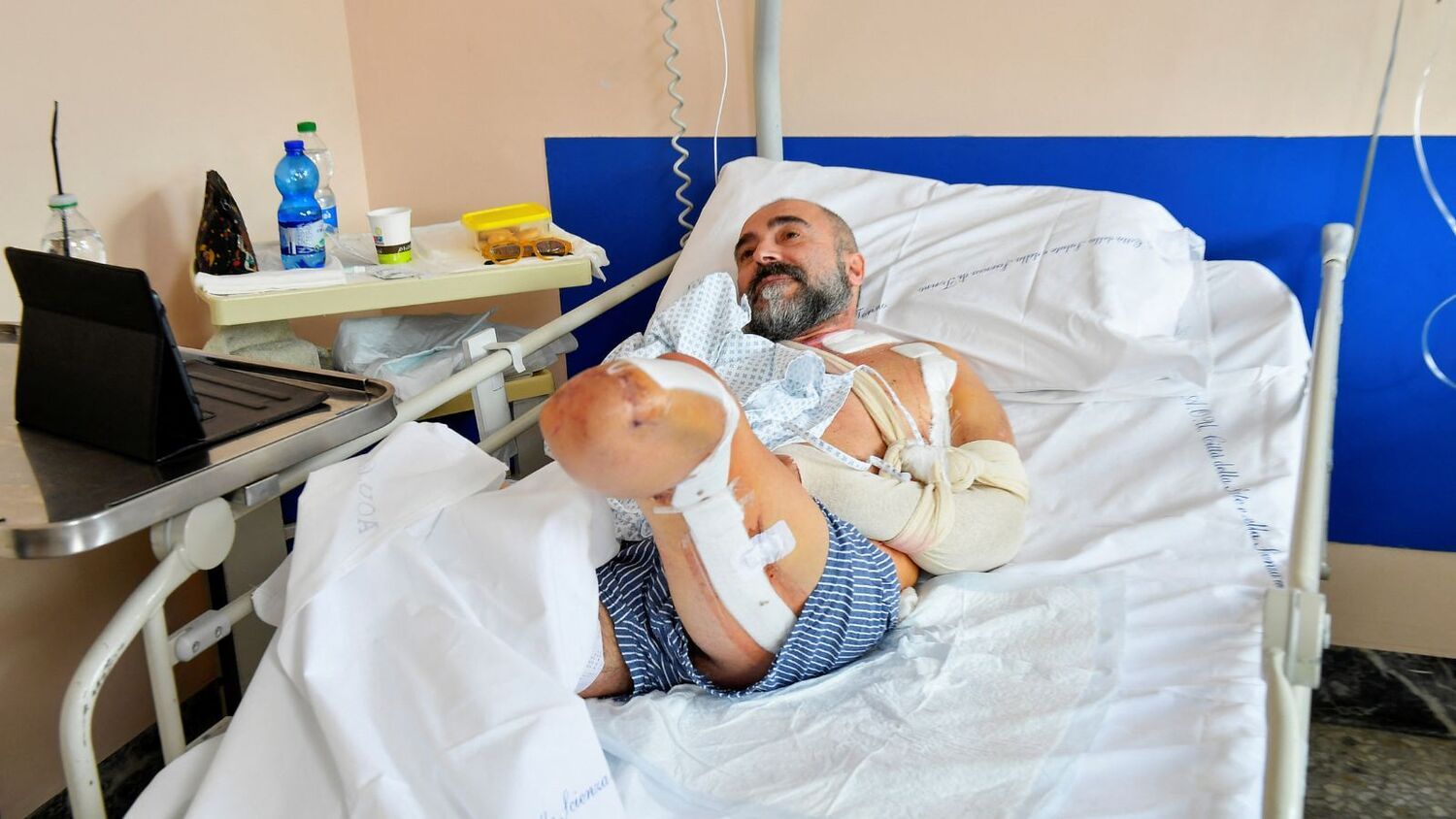 Italiano passa por transplante de nervo ciático de perna amputada para poder recuperar uso da mão – Notícias